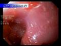 CryoSpray Ablation - High Grade Dysplasia