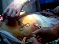 CHOLECYSTITIS
