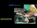 Ultrasound guided interscalene brachial plexus block