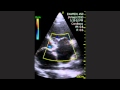 Tricuspidal Valve Impairment Tricuspidal Valve Impairment