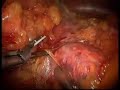 Laparoscopic left adrenalectomy Laparoscopic left adrenalectomy
