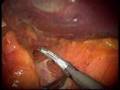 Laparoscopic left adrenalectomy