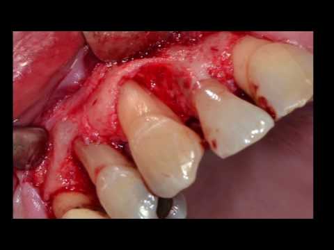 how to treat gum disease in dogs