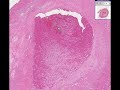 Histopathology Artery --Thrombus, Atherosclerotic plaque