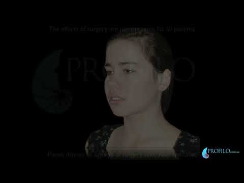 Profilo - This is a video showing before and after cases of jaw surgery. Jaw correction surgery is also called orthognathic surgery. Orthodontists and Oral & Maxillofa...