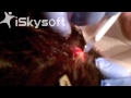 At-home Sebaceous Cyst Removal