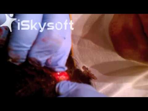how to drain sebaceous cyst at home