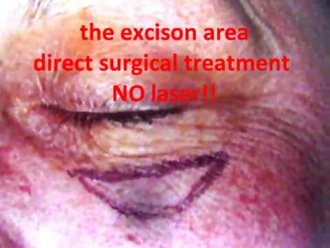 traitement poches yeux - les désespérantes poches malaires sont remplies par un 'oédeme récidivant! une opération des poches sous les yeux(blépharoplastie inférieure)ne suffit pas à ...