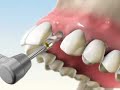dental implant video dental implant video