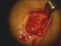 How To Pluck A Mass Out Of Someone\