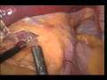 Lap-band_pars flaccida approach