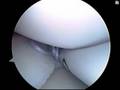 Arthroscopic Surgery Medial Meniscus Repair