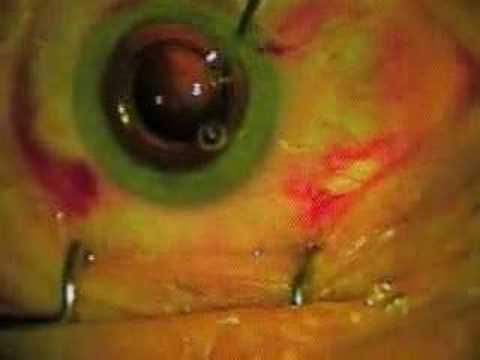 IOL-VIP - Intraocular Lens for Visually Impaired Pe