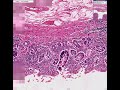 Histopathology Stomach--Chronic gastritis Gastritis