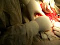 vertical incsion for removal of large uterine mass1