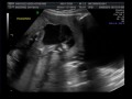 Twins Ultrasound Week 19 B/G Fraternal -Video 1 of 3
