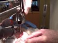 Profractional Laser Resurfacing -Step 2 -9-28-09