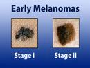 how to cure melanoma