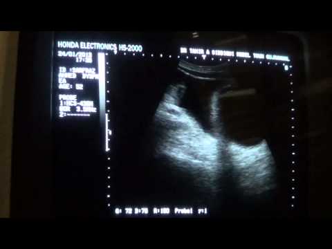 how to assess for ascites