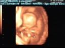 GRAVIMAGEM 15 (ultra-som obstetrico em terceira dimensão) GRAVIMAGEM 15 (ultra-som obstetrico em terceira dimensão)