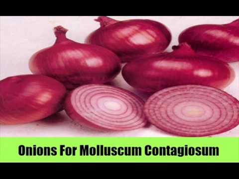 how to cure molluscum contagiosum
