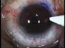Cirugia LASIK