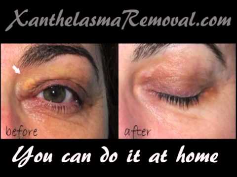 how to get rid of xanthelasma