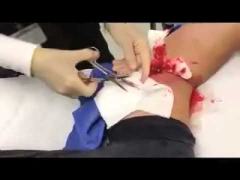 how to drain mrsa sore