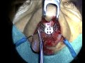 Breathe-Implant Surgery: a new titanium implant for the nose Breathe-Implant Surgery: a new titanium implant for the nose