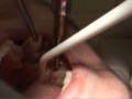 Tooth Extraction Demonstration