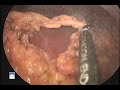 Laparoscopic Roux-en-Y Gastric Bypass - Dr. Smith