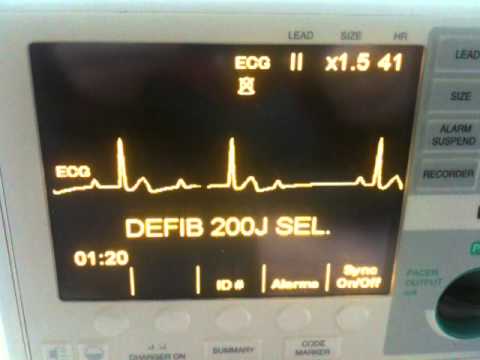 how to treat 2nd degree heart block