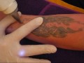 Tattooentfernung bei tattoo[los]