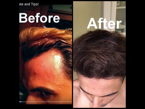 how to cure receding hairline