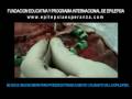 Cirugia de epilepsia