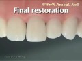 STEP5 Class IV Final