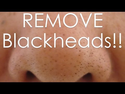 how to remove blackheads