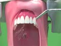 This is a demonstration of how to treat a patient who presents with an avulsed tooth.