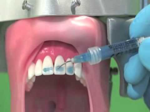 how to treat avulsion