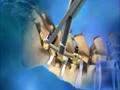 Live Webcast: Medtronic's CD HORIZON LEGACY PEEK Rod System