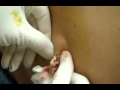 Vidéo Gore gros bouton dans le dos