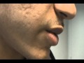 The Acne Practice  (3-D Scars.    A Stepwise Approach)