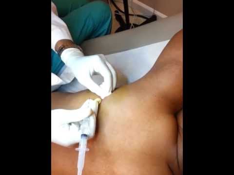 how to treat tick bites