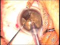 Prechop Phaco Part II