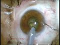 Ozil Brown Hard Cataract.
