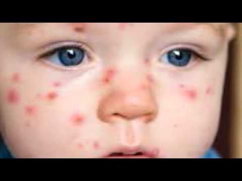 how to avoid chicken pox