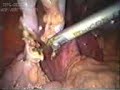 Click here to watch this video situs inversus totalis
