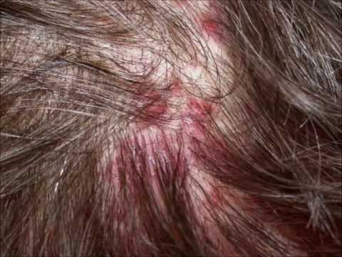how to treat scalp acne