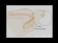 Osteosarcoma Proximal Humerus Part 2 of 6 Osteosarcoma Proximal Humerus Part 2 of 6