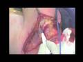 Osteosarcoma Resection Of The Humerus Proximal End - Part 2/6 Osteosarcoma Resection Of The Humerus Proximal End - Part 2/6